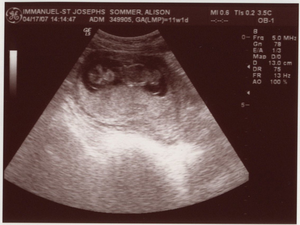 11 weeks pregnant. ultra-sound at 11 weeks,